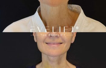 female patient before and after EVELIFT®