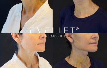 female patient before and after EVELIFT®