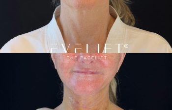 female patient before and after EVELIFT®