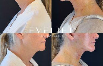 female patient before and after EVELIFT®