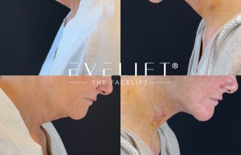 female patient before and after EVELIFT®