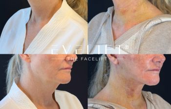 female patient before and after EVELIFT®