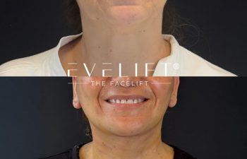 female patient before and after EVELIFT®