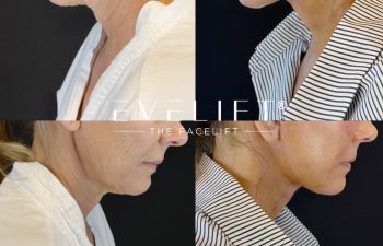 female patient before and after EVELIFT®
