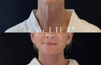 female patient before and after EVELIFT®