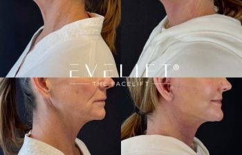female patient before and after EVELIFT®