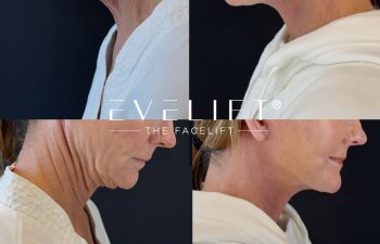female patient before and after EVELIFT®