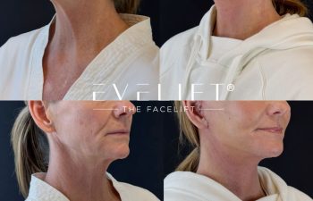 female patient before and after EVELIFT®
