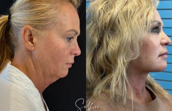 female patient before and after EVELIFT®