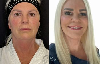 female patient before and after EVELIFT®