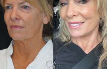 female patient before and after EVELIFT®