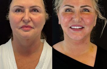female patient before and after EVELIFT®