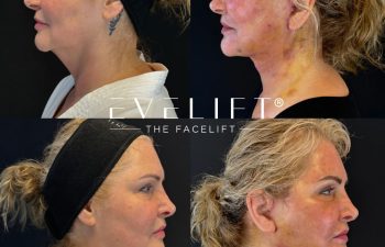 female patient before and after EVELIFT®