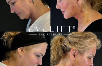 female patient before and after EVELIFT®