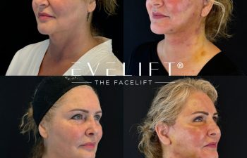 female patient before and after EVELIFT®