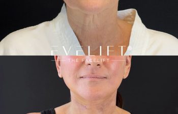female patient before and after EVELIFT®