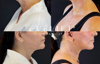 female patient before and after EVELIFT®