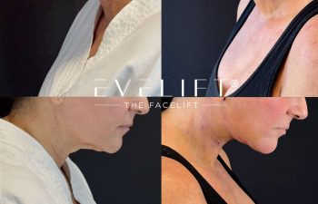 female patient before and after EVELIFT®