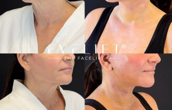 female patient before and after EVELIFT®