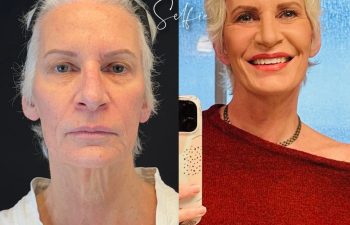 female patient before and after EVELIFT®