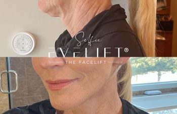 female patient before and after EVELIFT®