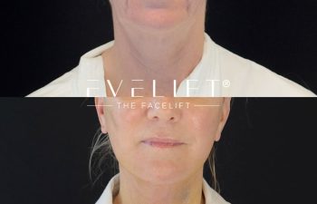 female patient before and after EVELIFT®