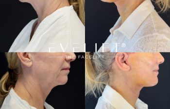 female patient before and after EVELIFT®