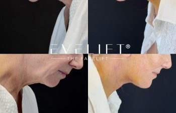 female patient before and after EVELIFT®