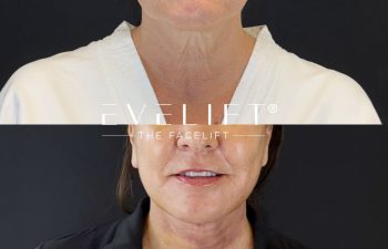female patient before and after EVELIFT®