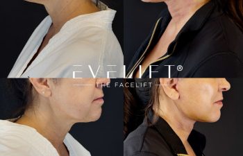female patient before and after EVELIFT®
