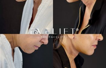 female patient before and after EVELIFT®