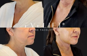 female patient before and after EVELIFT®