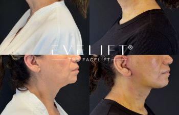 female patient before and after EVELIFT®
