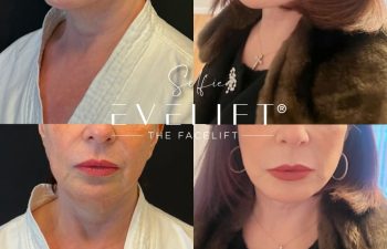 female patient before and after EVELIFT®