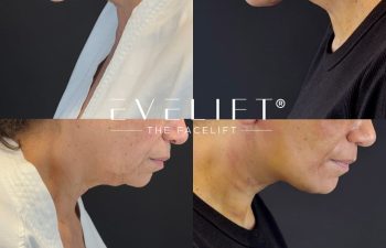 female patient before and after EVELIFT®