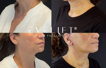female patient before and after EVELIFT®