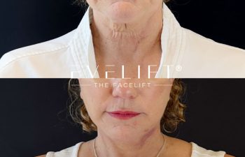 female patient before and after EVELIFT®