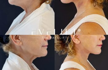 female patient before and after EVELIFT®