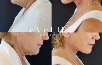 female patient before and after EVELIFT®