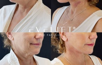 female patient before and after EVELIFT®