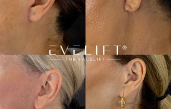 female patient before and after EVELIFT®