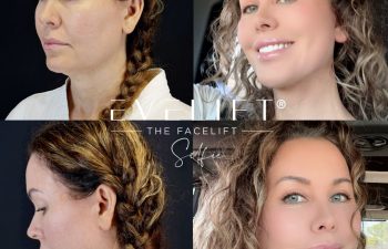 female patient before and after EVELIFT®