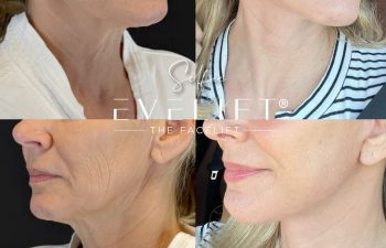 female patient before and after EVELIFT®