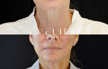 female patient before and after EVELIFT®