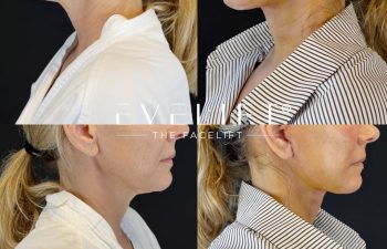 female patient before and after EVELIFT®