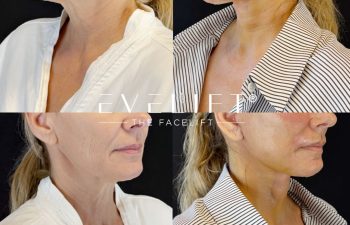 female patient before and after EVELIFT®