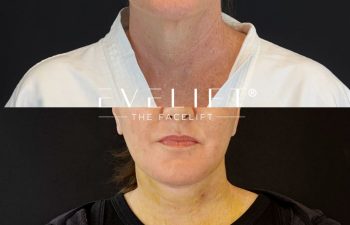 female patient before and after EVELIFT®