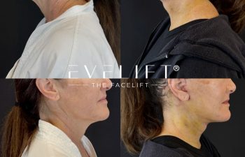 female patient before and after EVELIFT®