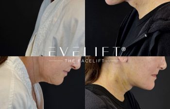 female patient before and after EVELIFT®