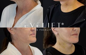 female patient before and after EVELIFT®